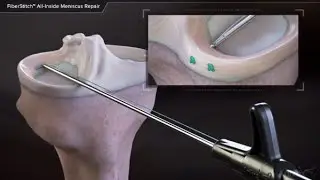 FiberStitch™ All-Inside Meniscus Repair