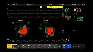 Clinical Decision Support: ST Map Animation