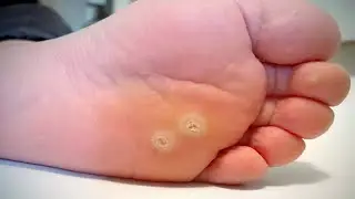 how to get rid of plantar warts overnight fast