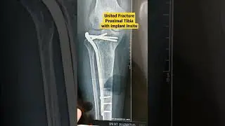 United Fracture Proximal Tibia with Implant Insitu..Dr Sai Chandra. Trauma, Joint Replacement..