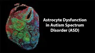 Astrocyte Dysfunction in Autism Spectrum Disorder (ASD) - Breaking News in Stem Cells