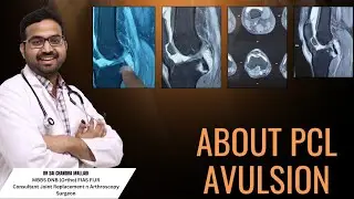 PCL Avulsion తెలుగు లో..X Ray బాగానే ఉంది కదా అని అశ్రద్ధ చేయకండి ...