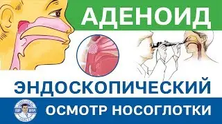 Эндоскопический осмотр ЛОР-органов - Аденоид 3ст ВЭС