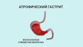 Атрофический гастрит. Причины, диагностика и тактика ведения