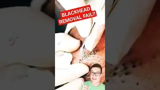 Super Old BLACKHEAD REMOVAL - Crazy Satisfying #shorts