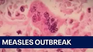 7 measles cases reported at Pilsen migrant shelter