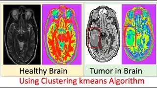 K Means Clustering Algorithm | K Means Brain Tumor Example in R | Machine Learning Algorithms