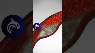 See what a Heart Attack looks like in your body - 3D Animation 