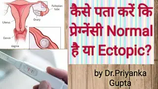 कैसे पता करें कि प्रेग्नेंसी नॉर्मल है या एक्टोपिक# pregnancy#ectopic pregnancy