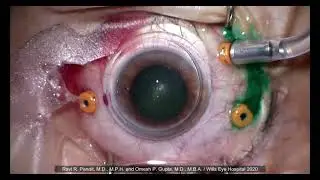 Epiretinal Membrane Peel