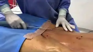 🔥 LIPOESCULTURA 🔥 ABDOMINAL ETCHING Marcación Abdominal Mujeres (Lipomarcación) ► Dr John Garcia