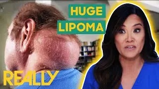 Dr. Lee Removes A Massive Lipoma From A Man's Neck | Dr. Pimple Popper