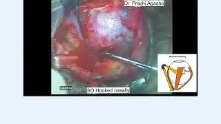 AIOC2023 - VT27 - Dr.PRACHI AGASHE Surgical management of acquired Brown`s syndrome secondary to...