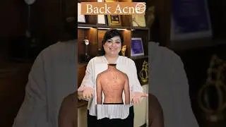 How to get rid of back acne? | Back acne treatment | Lacne Body Spray | Best dermatologist in Delhi