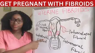 Uterine Fibroids ; Types, Causes, Symptoms & Treatment Of Uterine Fibroids