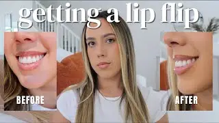 Getting a Lip Flip with Botox | My First Time Experience & Results