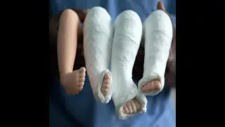 Ponseti technique for Clubfoot