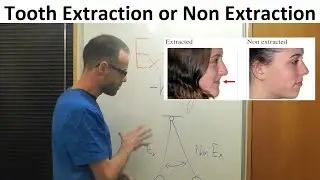 History of Teeth Alignment with Extraction or Non  Extraction Method in Orthodontics by Dr Mike Mew