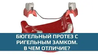 Бюгельные протезы: бюгельный протез с ригельным замком