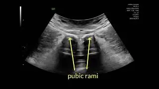 #UOGjournal videoclip on the measurement of transverse diameter of levator hiatus in coronal view