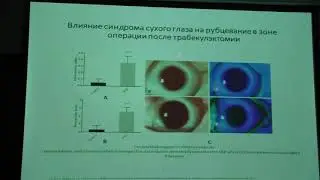 Глаукома и синдром сухого глаза