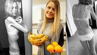 Hours From Death: Anorexia Sufferer’s Incredible Recovery