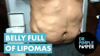 Dr Pimple Popper Removes Belly Full of Lipomas