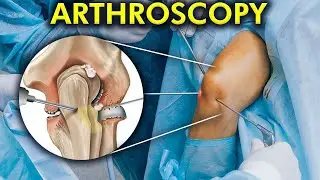 The World of Arthroscopic Surgery: How Arthroscopy is performed (Include 3d animation)