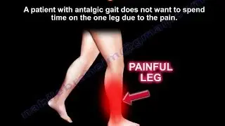 Antalgic Gait - Everything You Need To Know - Dr. Nabil Ebraheim