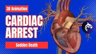 Cardiac Arrest (Sudden Death) - 3D Animation