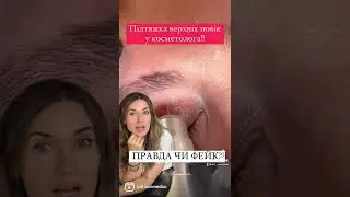 Блефаропластика повік у косметолога!  ПРАВДА чи ФЕЙК?