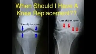 Do I Need A Knee Replacement