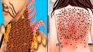 Asmr animation removal worm from infected backside