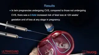 #UOG video abstract on chorionic villus sampling in twin pregnancy