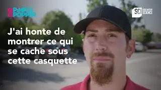 J'ai honte de montrer ce qui se cache sous cette casquette | Dr Pimple Popper