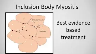 Inclusion Body Myositis Treatment