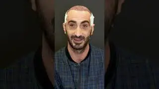 Quartz Clinique Patient´s review about Hair Transplant in Turkey