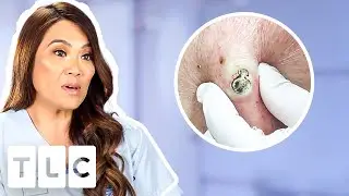 Top 5 Pimple Popping Moments: From A 55-Year-Old Blackhead To Oozing Fistulas!