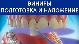 Виниры - Подготовка и наложение ©