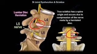 Sacroiliac join dysfunction.