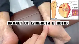 Падает от слабости в ногах.Стеноз позвоночного канала.Подагра.Тофусы. #стеноз #тофусы #подагра #топ