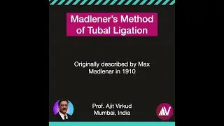 Madleners Method of tubal ligation