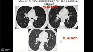 Сперанская А А Вирусная пневмония Covid 19