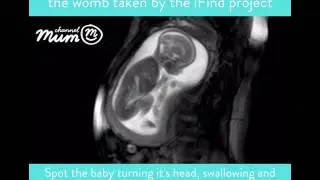 MRI Scan Video of Baby Moving in Womb | Channel Mum