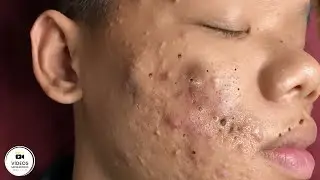 Squeezing Blackheads and Pimples - Relaxing and Satisfying 😍