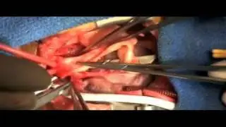 HLHS - Pediatric Heart Surgery