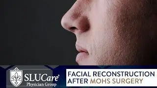 Facial Reconstruction after Mohs Surgery - SLUCare Otolaryngology
