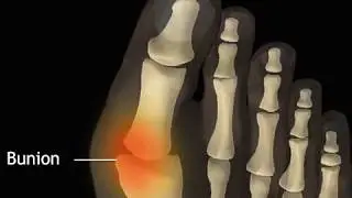 How Bunions are Formed Animation - Bunion Symptoms and Causes Video