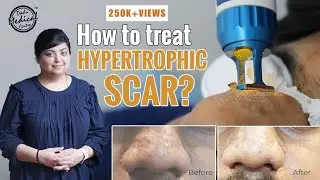 How To Treat Hypertrophic Scar? | Hypertrophic Acne Scar | Bumps on Nose | Dr. Nivedita Dadu