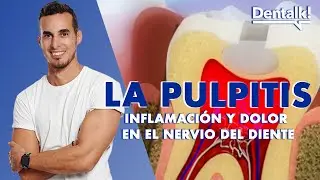 ¿Dolor intenso de muela? Podría ser PULPITIS - Tratamiento INFLAMACIÓN NERVIO dental | Dentalk! ©